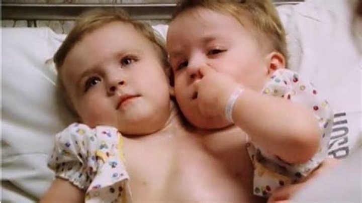 Eilish Holton Now Conjoined twins, Holton, Twins
