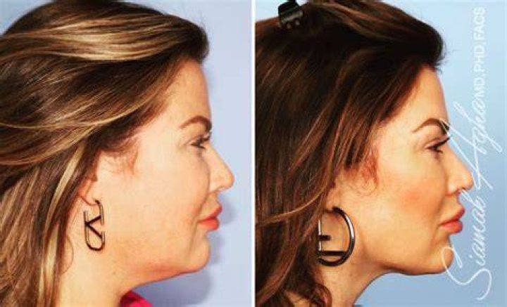 Emily Simpson Shares New Before & After Photos from Her Recent Lower