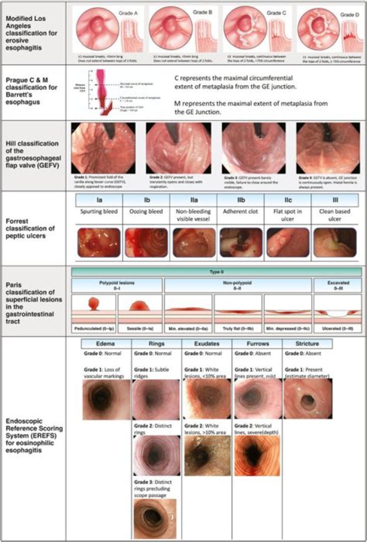 Endoscopic findings showing a. Gastric antrum Erythematous mucosa