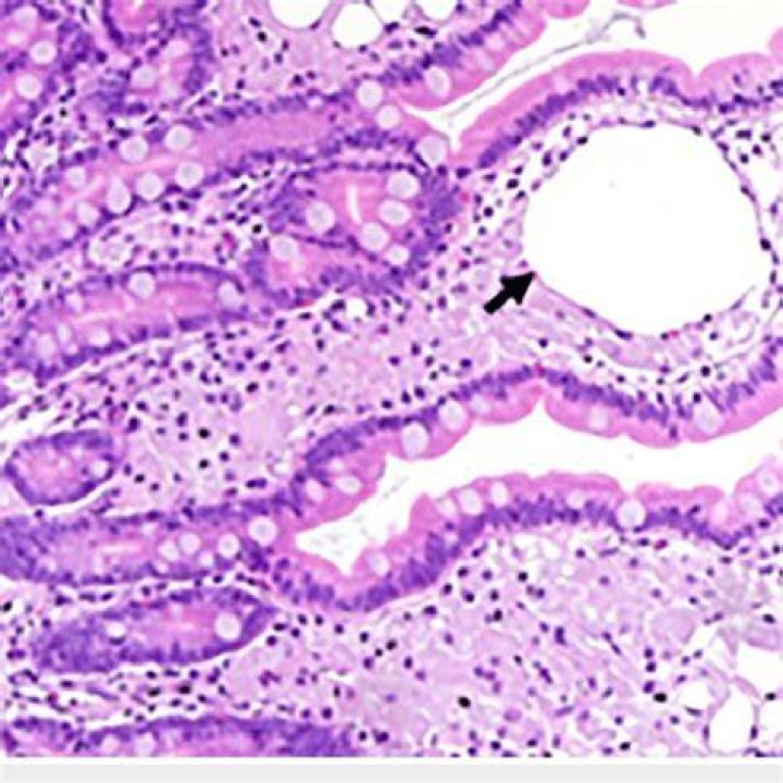 Erythematosus duodenal mucosa with diffuse haemorrhagic suffusions (A