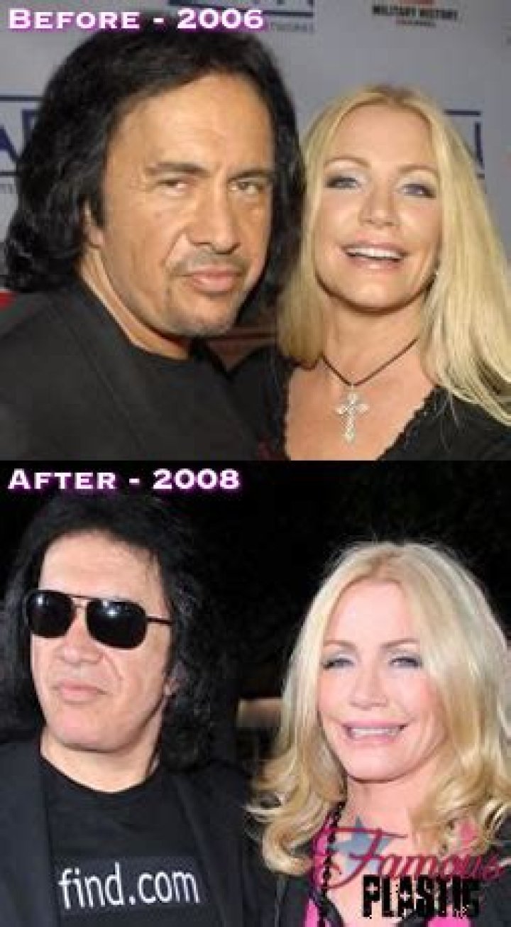 Gene Simmons Plastic Surgery Before and After Facelift Photos Gossip