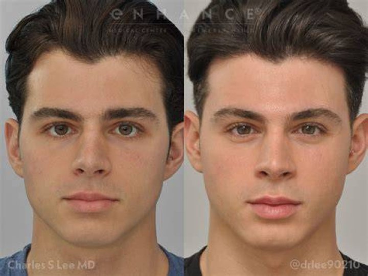 Get Pierre Boo Plastic Surgery Nick And Pierre Before And After US