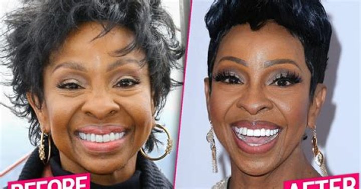 Gladys Knight Unrecognizable After Plastic Surgery