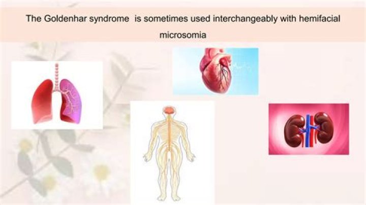Goldenhar Syndrome: Unveiling The Mysteries And Empowering The Journey