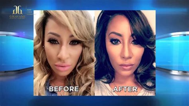 Hazel E Before And After Plastic Surgery