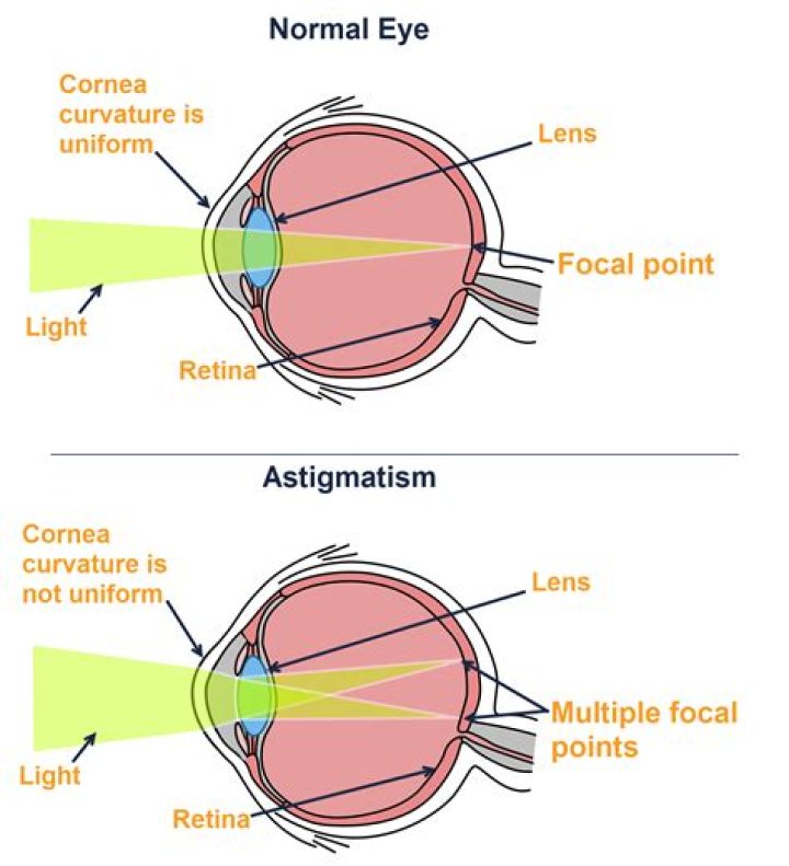 How Astigmatism Affects Vision Davis Vision Center