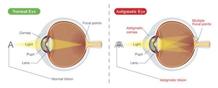 I have astigmatism, so does that mean I'm not suitable for laser eye
