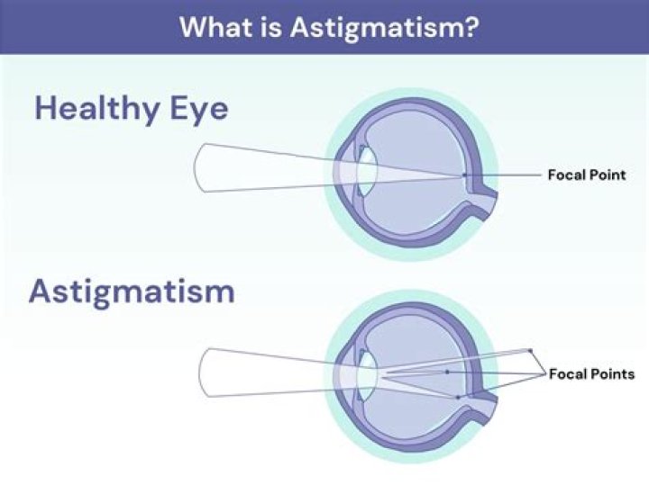 If You Have Astigmatism, This Is What Lights Look Like Truth or Fiction?