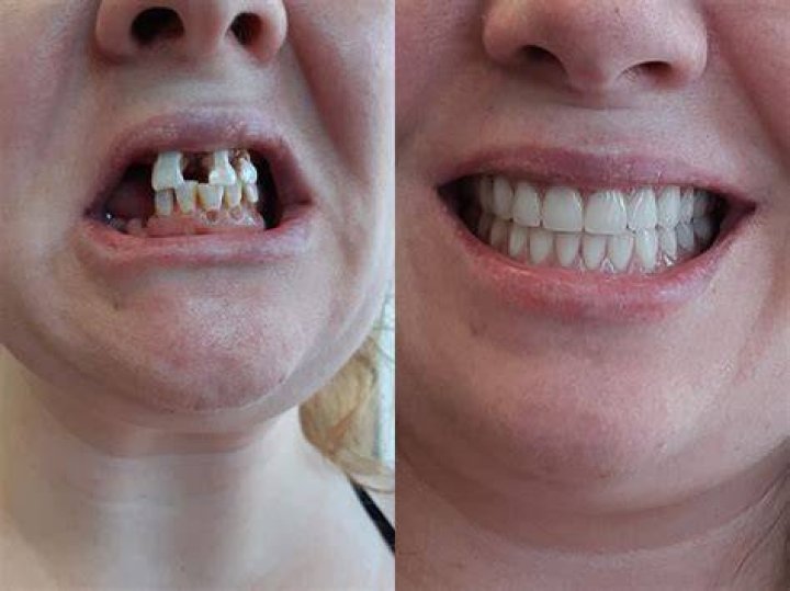 Immediate Dentures, Emergency Dentures Barrie Denture Clinic