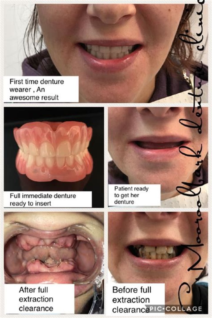 Immediate Dentures Smile Again Denture Clinic