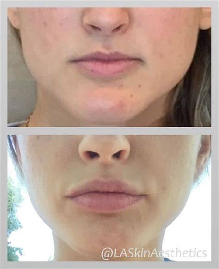 Instagram photo by LA SkinAesthetics &bull; Apr 3, 2016 at 739pm UTC