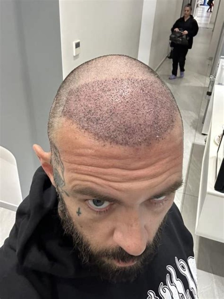 Is Adam22 Bald?