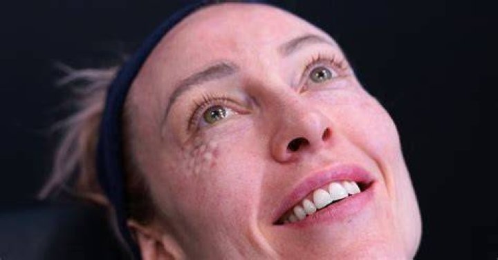Jelly Roll Botox A Guide for Effective Results BeautyKylie