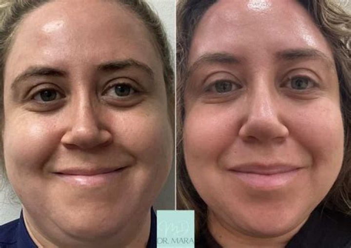 Jelly Roll Botox Is Trending&mdash;Here's What You Should Know Marie Claire UK