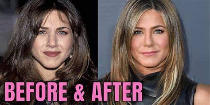 Jennifer Aniston Plastic Surgery Before And After Pictures