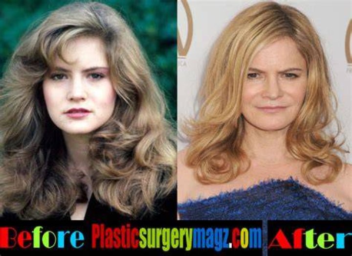 Jennifer Jason Leigh Plastic Surgery facelifts, filler infusions, and