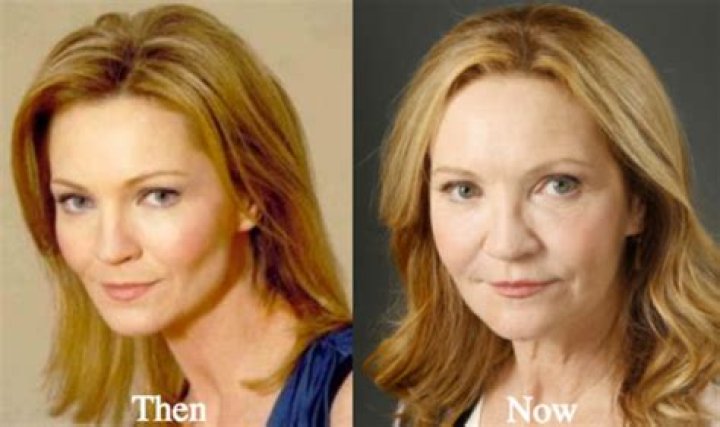 Joan Allen Plastic Surgery Before and After