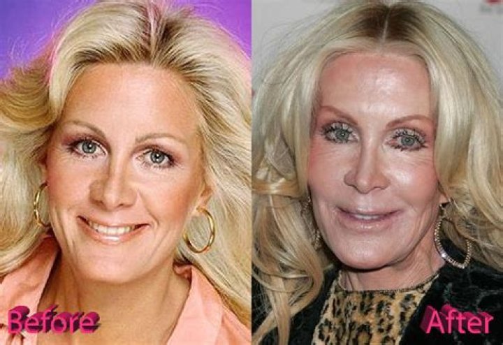 Joan Van Ark Plastic Surgery Before and After Rhinoplasty and Cheek