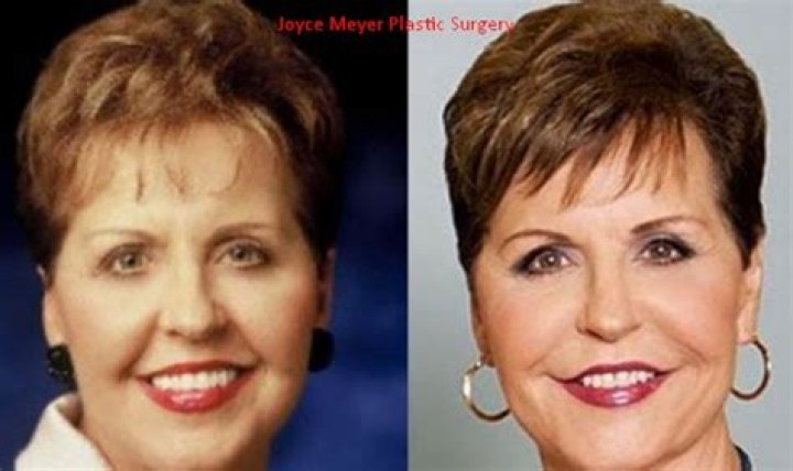 Joyce Meyer Plastic Surgery Chin Improvement, Lip augmentation, Facelift