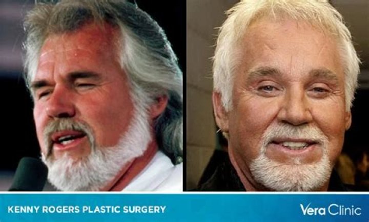 Kenny Rogers Transformation After Plastic Surgery Verge Campus