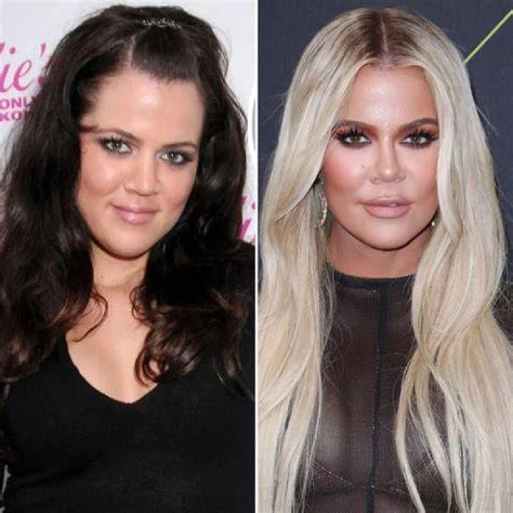 Khloe Kardashian's plastic surgery secrets revealed
