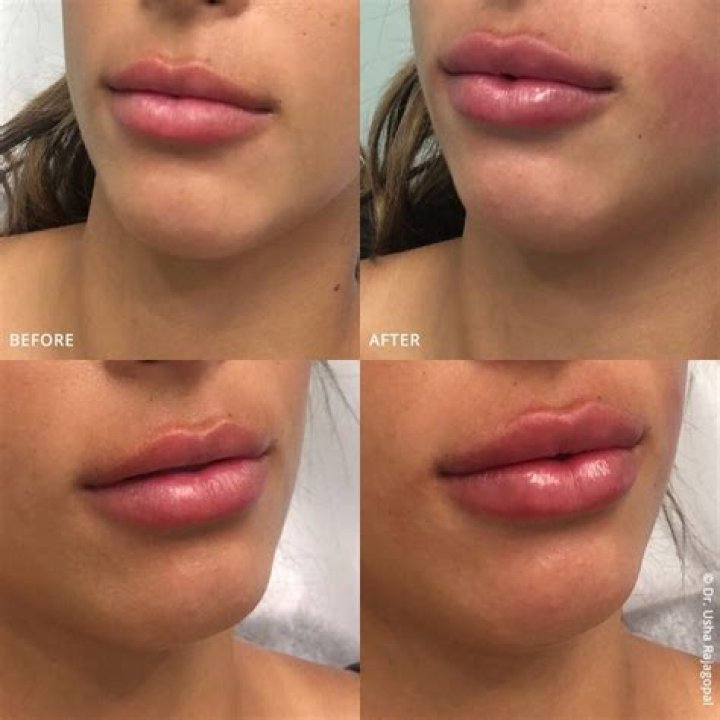 Madelyn Cline lip fillers and nonsurgical nose job Scrolller