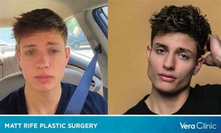 Matt Rife Plastic Surgery And Weight Loss Details Age