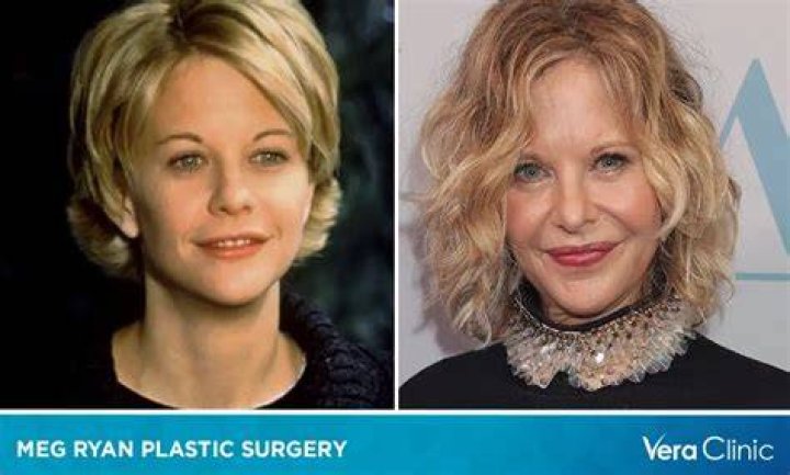 Meg Ryan Plastic Surgery To Rejuvenate Her Look, Meg Ryan Got Botox