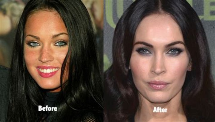 Megan Fox Plastic Surgery Transformation Revealed By Top Doctors