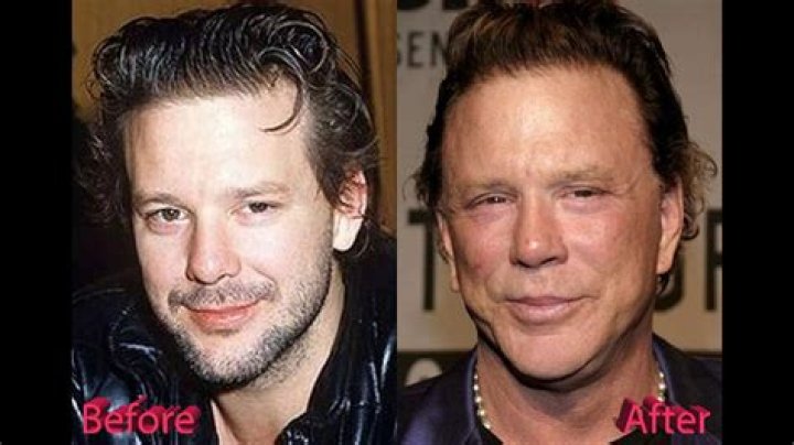 Mickey Rourke Before And After Plastic Surgery Mickey rourke plastic