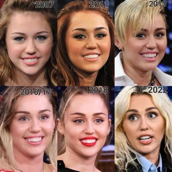 Miley Cyrus Since we are on a buccal fat removal roll, thoughts? r