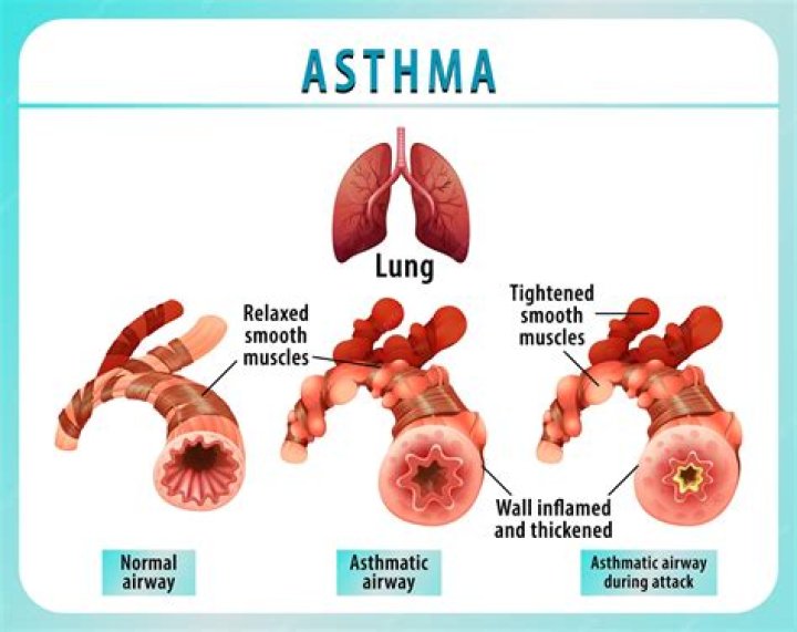 Millions of asthma sufferers beware! EASTER EGGS could trigger deadly