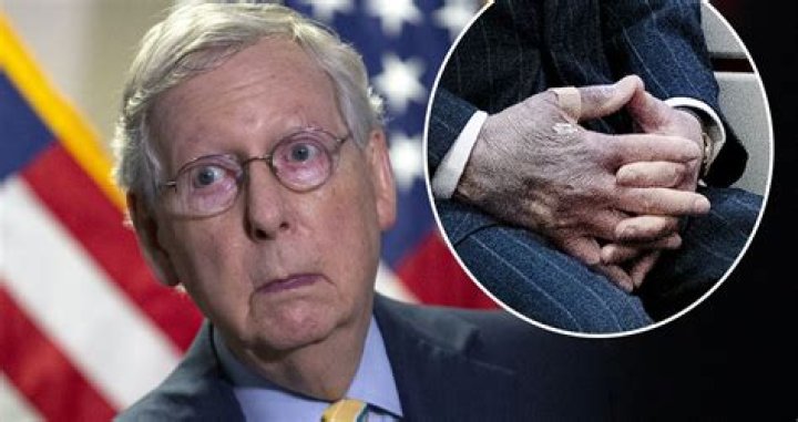 Mitch McConnell&rsquo;s mysteriously bruised hands spark health questions