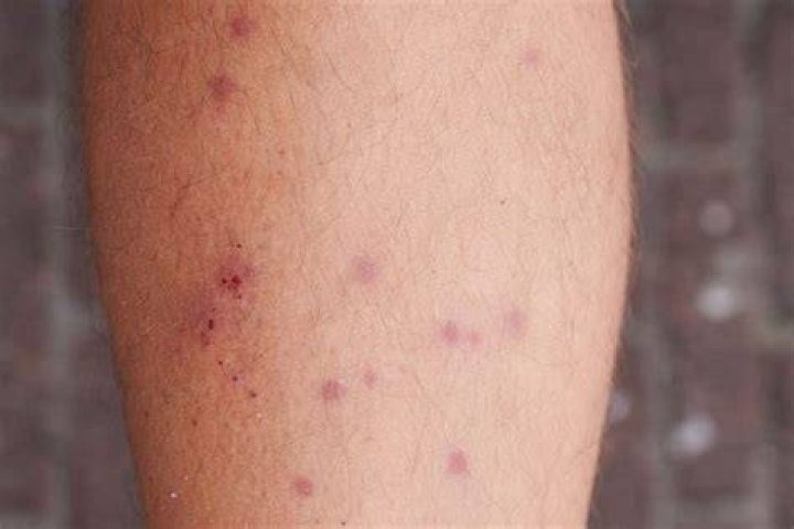 Mite Bites What To Know The Family Handyman