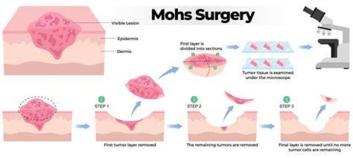 Mohs Surgery For Expert Skin Cancer Removal