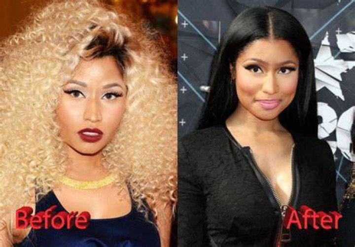 Nicki Minaj Plastic Surgery Before and After icezen