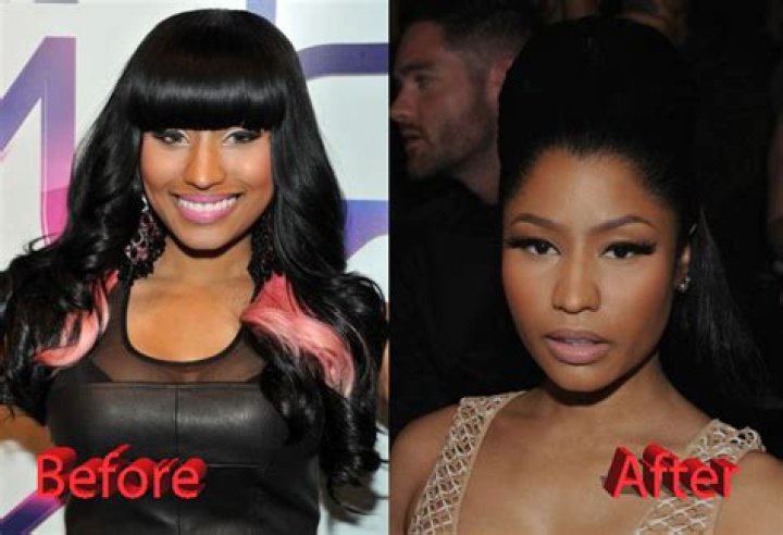 Nicki Minaj Plastic Surgery Fact or Not?
