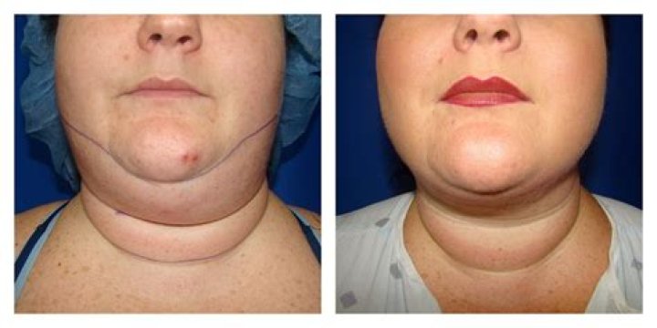 Patient 200 Female Liposuction Before and After Photos Katy Plastic