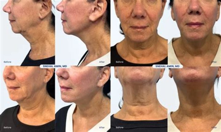 Patient Q&A Neck Liposuction Dermatology, Laser & Vein Specialists