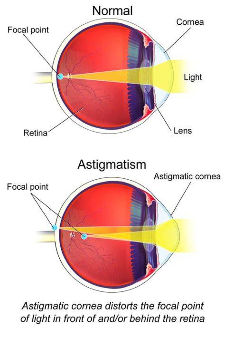 People Realize They Have Astigmatism After These Comparison Photos Go