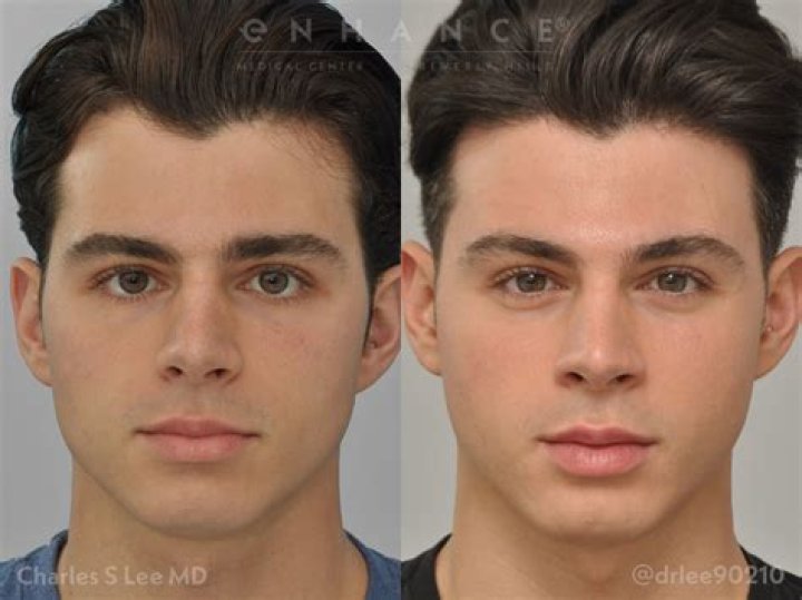 Pierre Boo Plastic Surgery [REVEALED] FitGAG