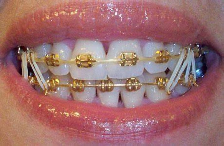 Pin by Lauuuuuren on BRACES & GRILLZ Teeth braces, Braces tips, Cute