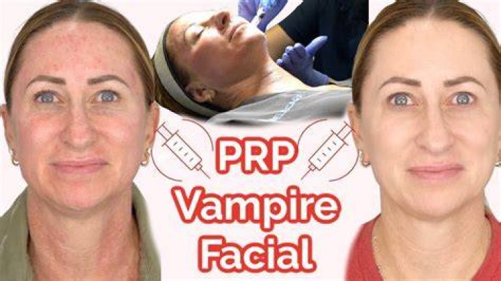 PRP Blood Facial Cost, Reviews, Before And After Los Angeles