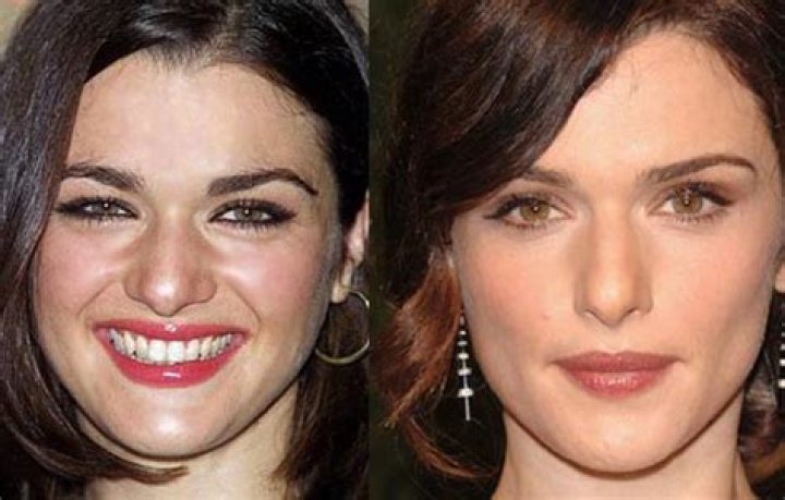 Rachel Weisz Facelift Plastic Surgery Before and After Celebie