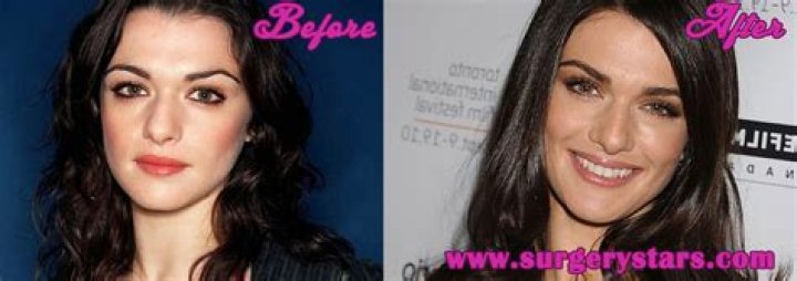 Rachel Weisz Plastic Surgery Before and After Pictures 2024