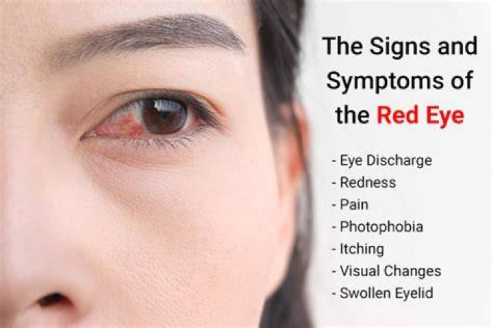 Red Eyes Symptoms, Causes, and Treatments