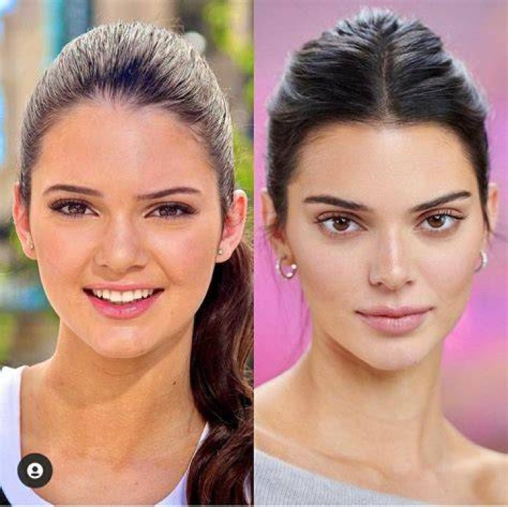 Rhinoplasty Before And After Celebrity Edition — Atlantic Health Solutions