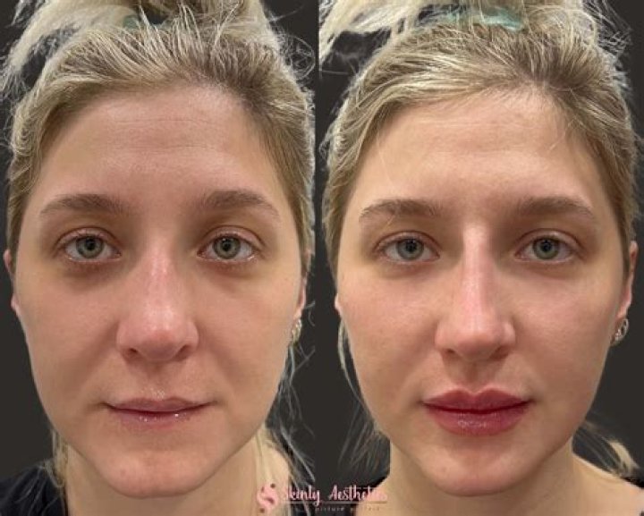 Rhinoplasty, Lip Filler, Cheek Implants (Bad Bunny) Rhinoplasty, Lip