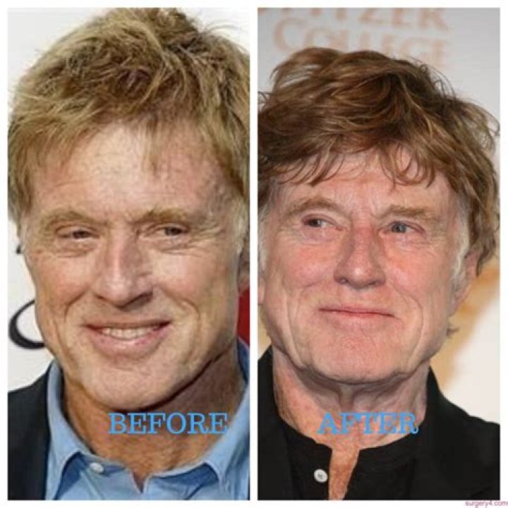 Robert Redford Face Lift Before And After Photos