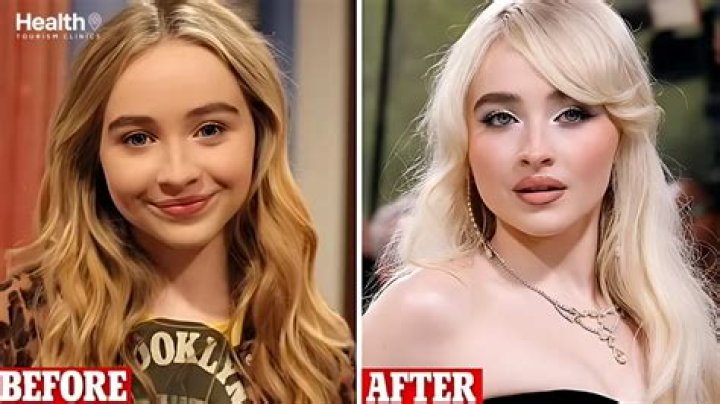 Sabrina Carpenter Plastic Surgery Nose Job, Lip Shots and Botox